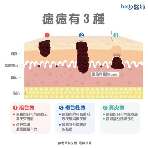 痣為什麼會長毛|痣形成的原因？痣長毛、痣變多變大是痣病變？5招判。